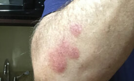 Bed bug bites